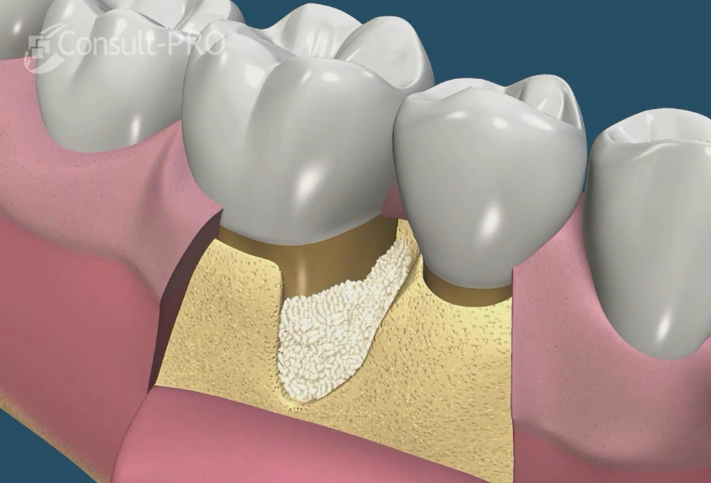 Caso regeneración 3